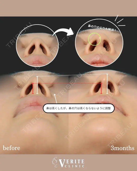 鼻中隔延長＋貴族手術｜中顔面発達✨ after画像 メイン用