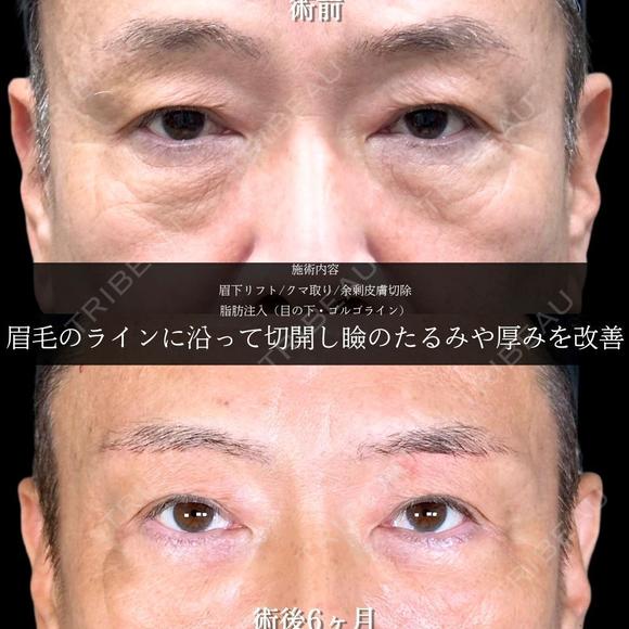 眉下リフト/クマ取り/脂肪注入(目の下・ゴルゴライン)/余剰皮膚切除 before画像 メイン用