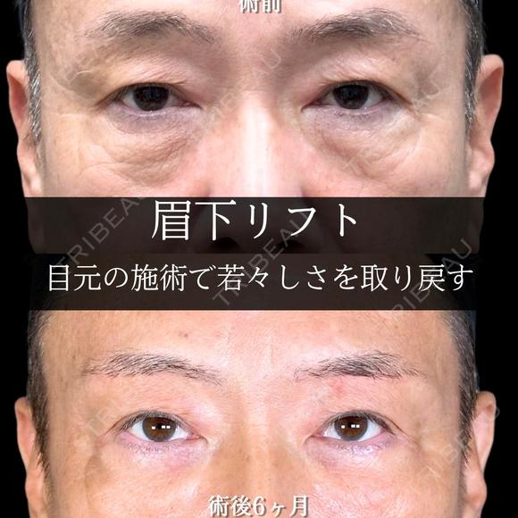 眉下リフト/クマ取り/脂肪注入(目の下・ゴルゴライン)/余剰皮膚切除 180日後 メイン用
