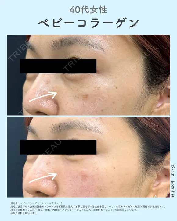 ベビーコラーゲン(ヒューマラジェン) after画像 メイン用