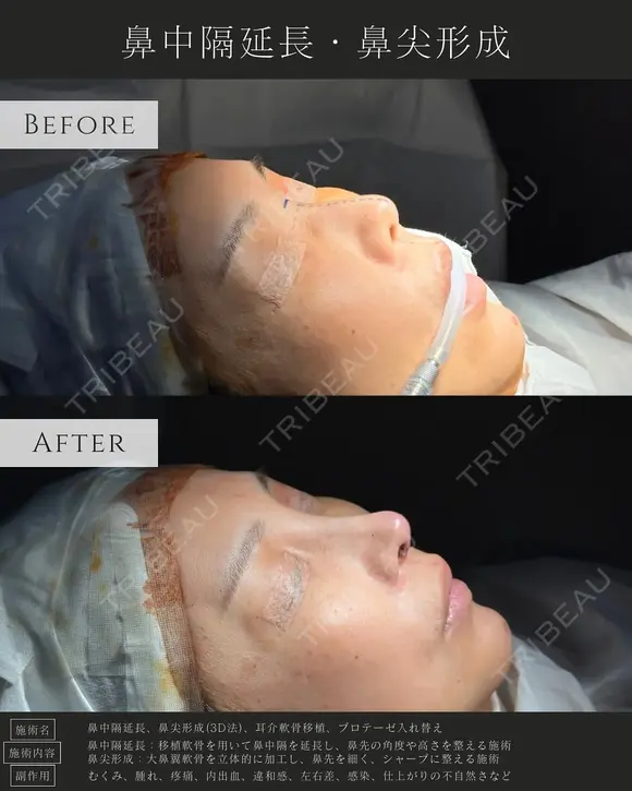 鼻中隔延長、鼻尖形成 before画像 メイン用