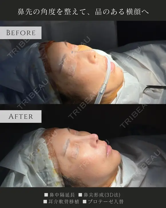 鼻中隔延長、鼻尖形成 after画像 メイン用