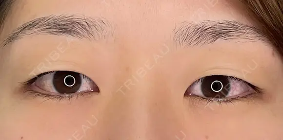 【二重埋没法】自然癒着法 before画像 メイン用
