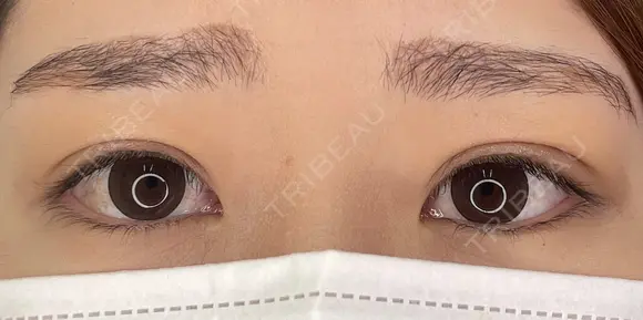 【二重埋没法】自然癒着法 after画像 メイン用