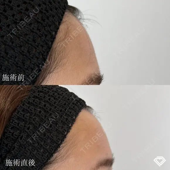 おでこ・こめかみのデザイン注射（ヒアルロン酸） after画像 メイン用