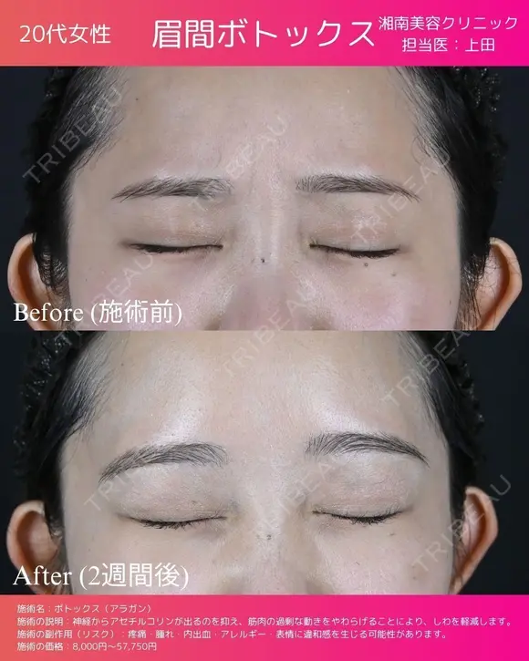 アラガン製ボトックス before画像 メイン用