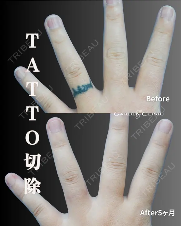 タトゥー除去（切除法）のご紹介💁🏻‍♀️ before画像 メイン用