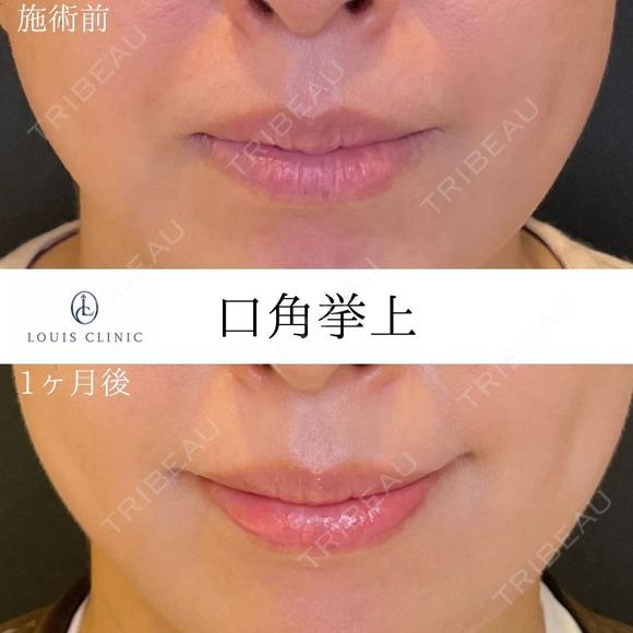 口角挙上 before画像 メイン用