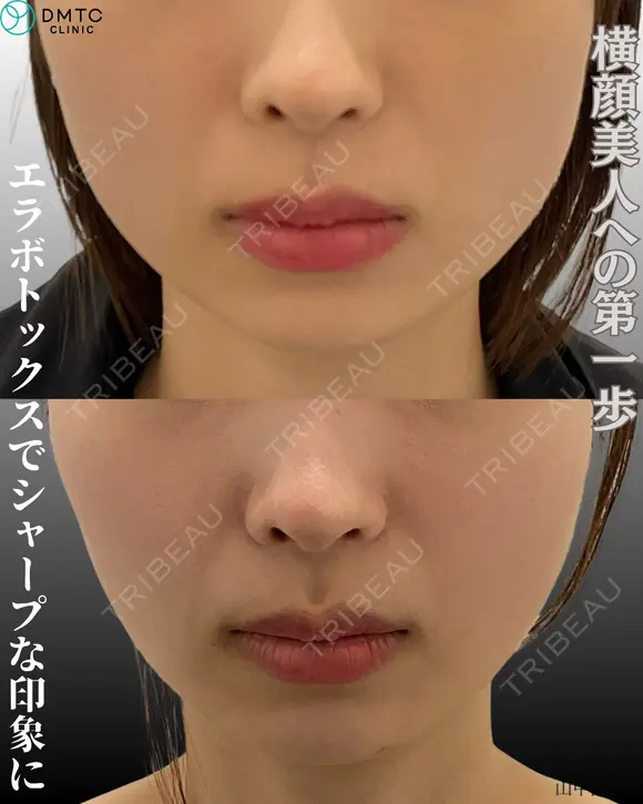エラボトックス before画像 メイン用