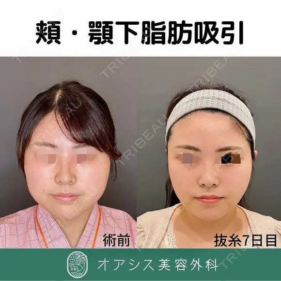 脂肪吸引（頬＋顎下） before画像 メイン用