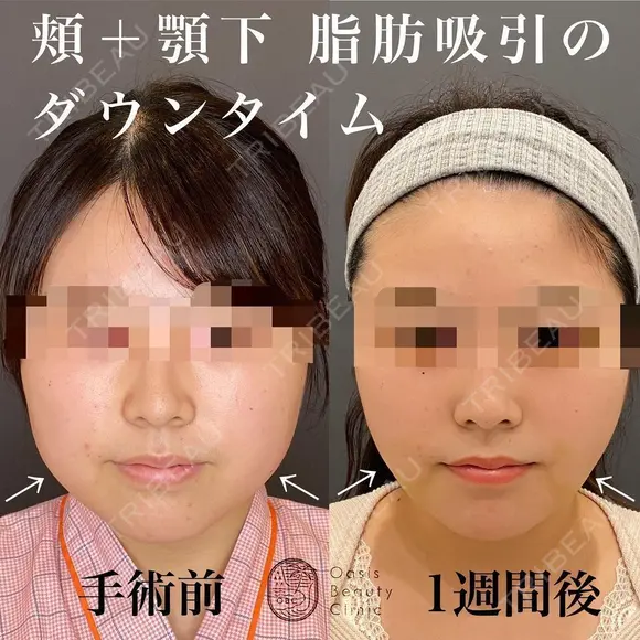 脂肪吸引（頬＋顎下） after画像 メイン用