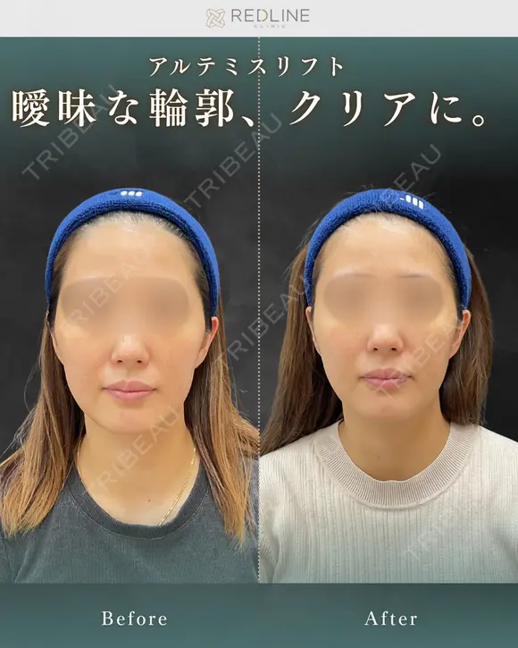 アルテミスリフト(糸リフト) before画像 メイン用