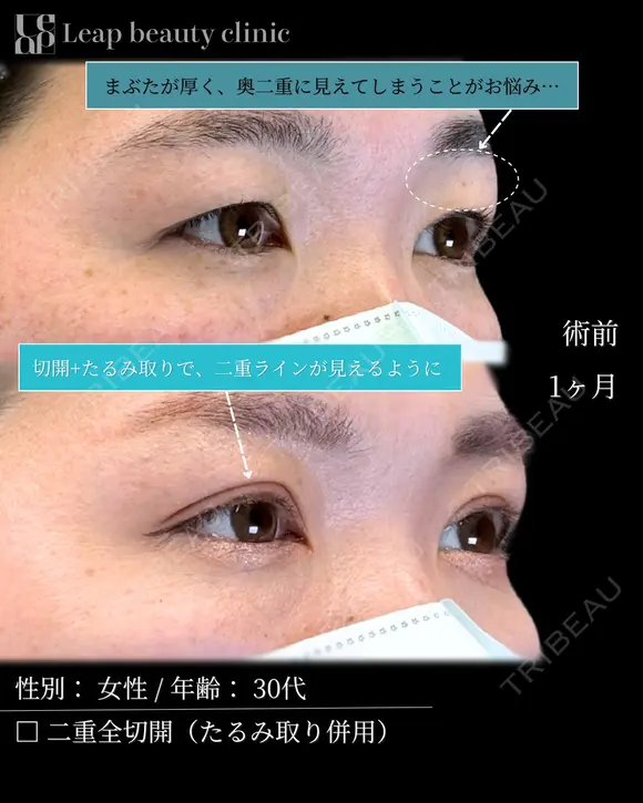 二重前切開＋たるみ取り併用 before画像 メイン用