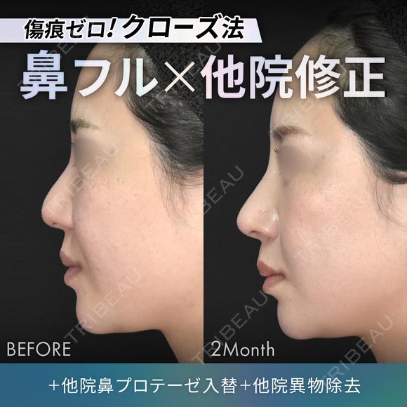 他院鼻プロテーゼ入替＋他院異物除去＋鼻フルコース［クローズ法］（鼻複合自家組織移植術） before画像 メイン用