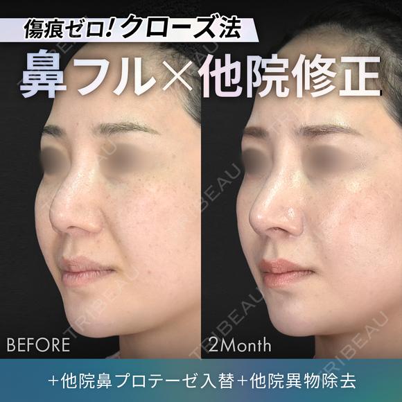 他院鼻プロテーゼ入替＋他院異物除去＋鼻フルコース［クローズ法］（鼻複合自家組織移植術） after画像 メイン用