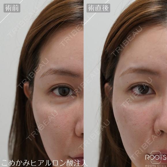 ヒアルロン酸｜ニューラミス｜1cc｜涙袋・鼻・あご・ゴルゴラインなどから選べる after画像 メイン用
