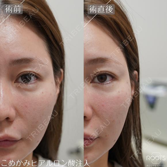 ヒアルロン酸｜ニューラミス｜1cc｜涙袋・鼻・あご・ゴルゴラインなどから選べる before画像 メイン用