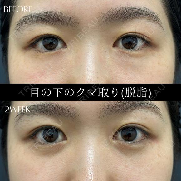 目の下のふくらみ、脂肪取り（クマ取り） after画像 メイン用