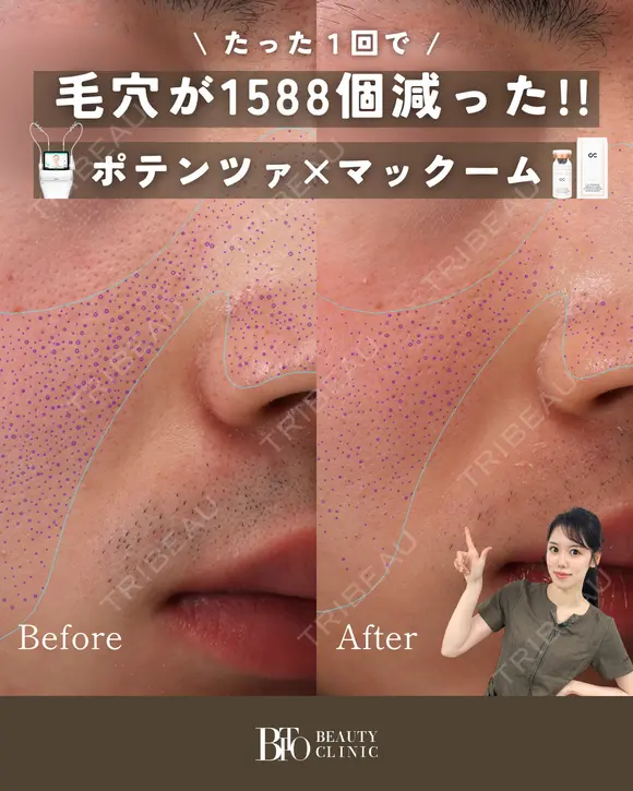 ポテンツァマックーム導入 1回 after画像 メイン用