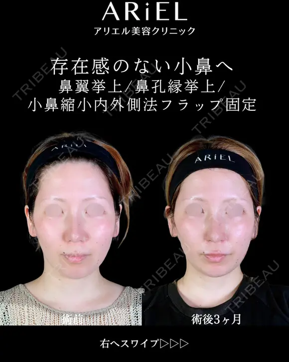 鼻翼挙上/鼻孔縁挙上/小鼻縮小内外側法(フラップ固定) 90日後 メイン用