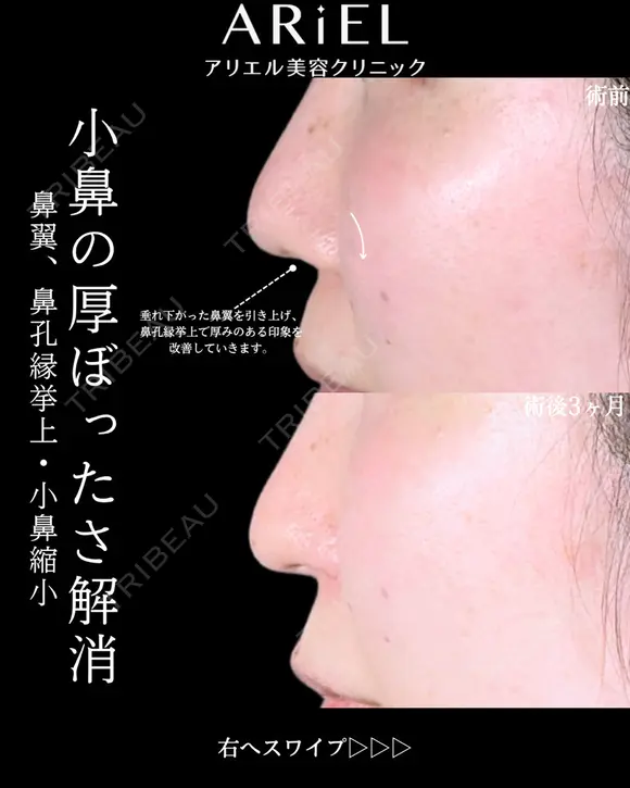 鼻翼挙上/鼻孔縁挙上/小鼻縮小内外側法(フラップ固定) before画像 メイン用