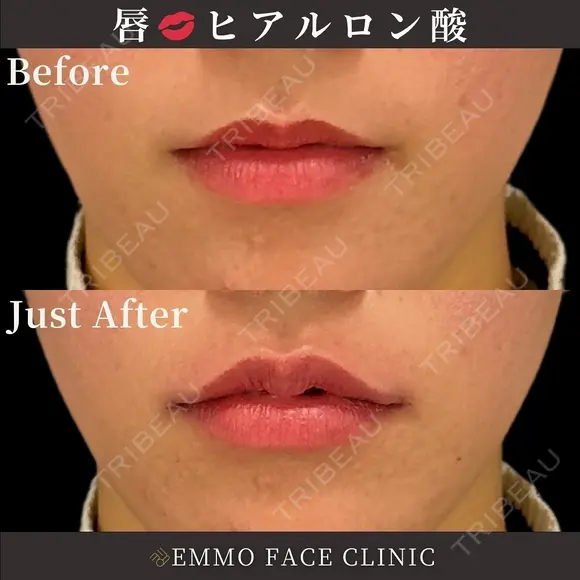 ヒアルロン酸(唇) before画像 メイン用