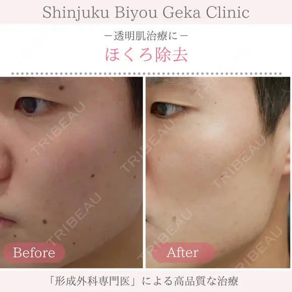 ほくろ除去 before画像 メイン用