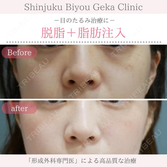 脱脂＋脂肪注入 before画像 メイン用