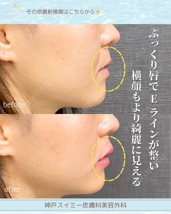 唇ヒアルロン酸 before画像 メイン用