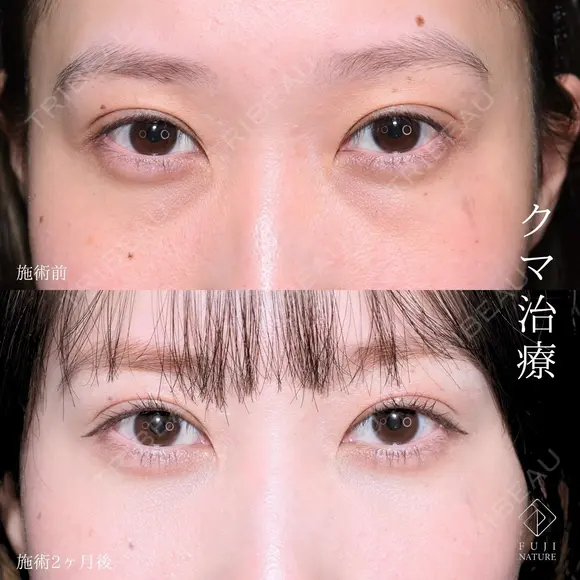 クマ取り  ”老け顔”や“お疲れ顔“とサヨナラ👋 before画像 メイン用