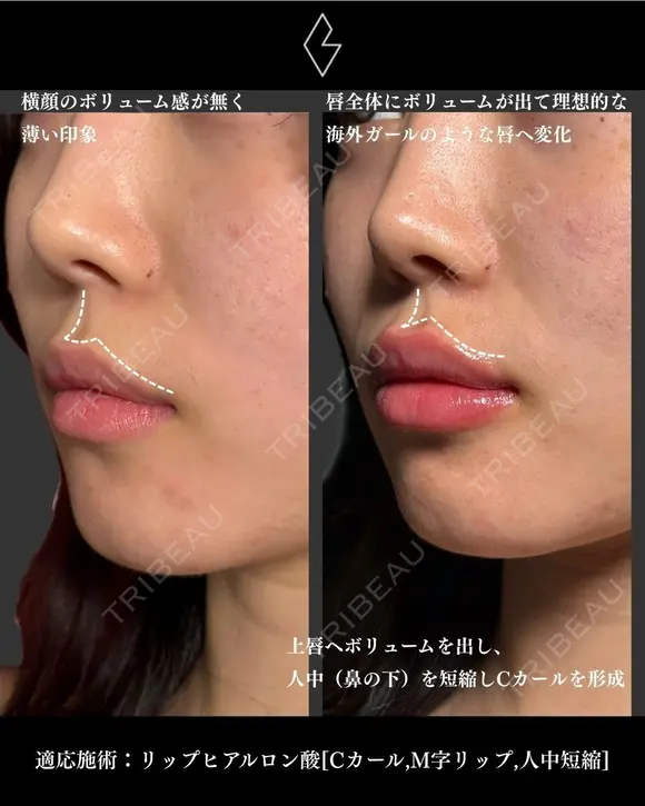 唇ヒアルロン酸 before画像 メイン用