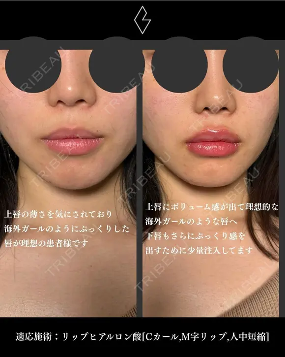 唇ヒアルロン酸 after画像 メイン用