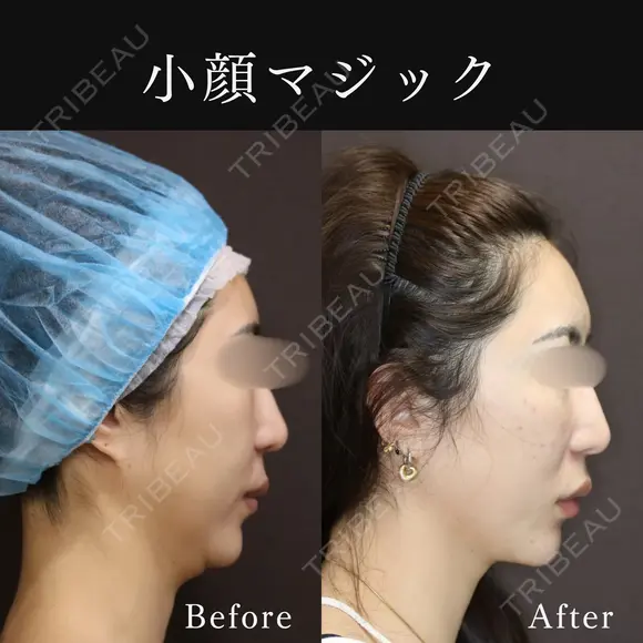 小顔マジック before画像 メイン用