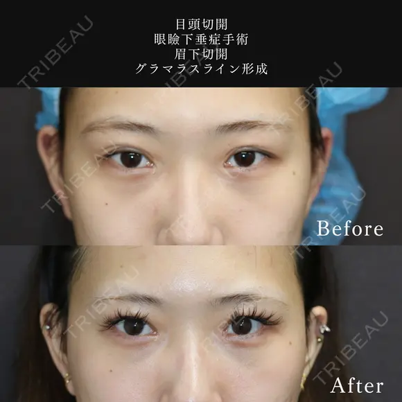 目頭切開＋眼瞼下垂症手術＋眉下切開＋グラマラスライン形成 30日後 メイン用