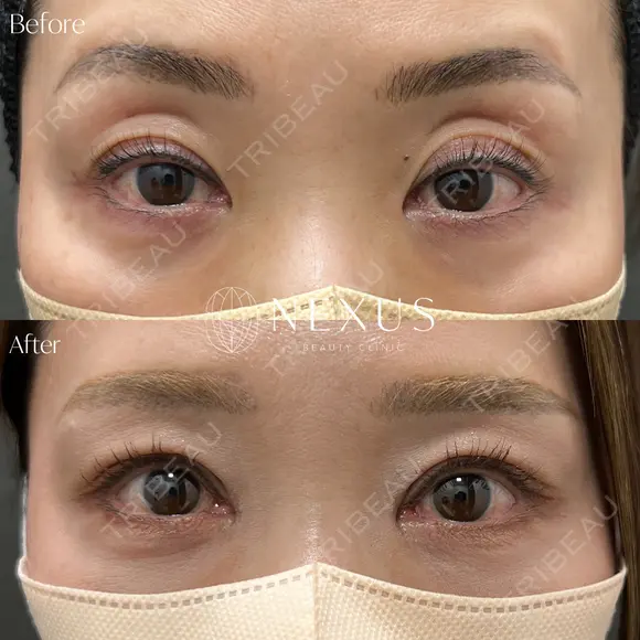 眼瞼下垂＋目頭切開 after画像 メイン用