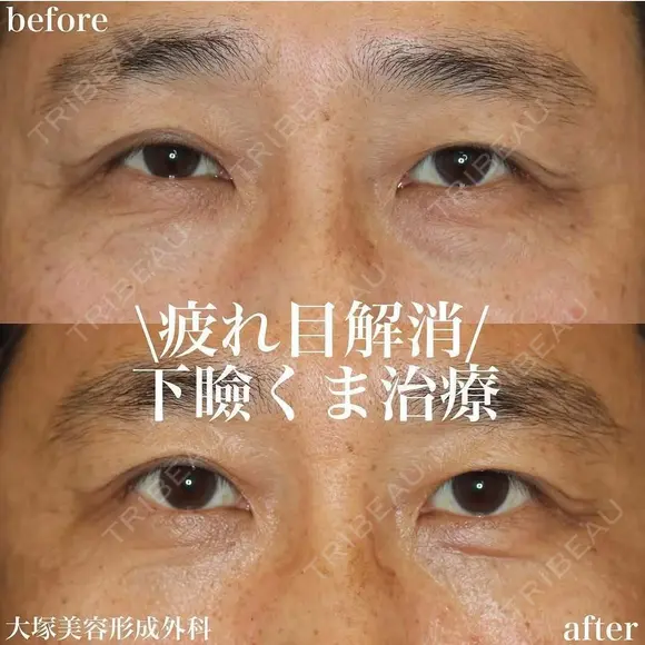 下瞼結膜側ハムラ法 after画像 メイン用