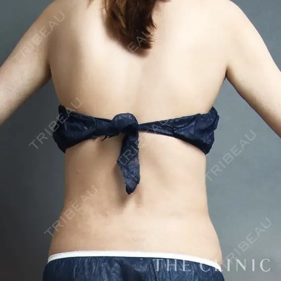 腰のベイザー脂肪吸引 after画像 メイン用