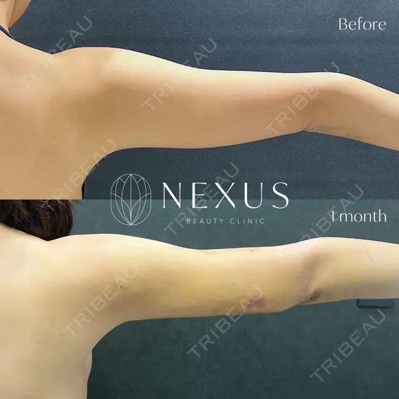 脂肪吸引（二の腕） before画像 メイン用