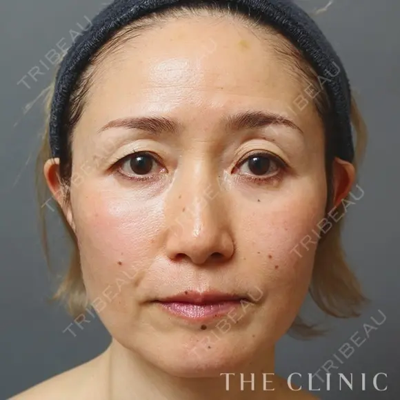 顔のSRF注入 before画像 メイン用