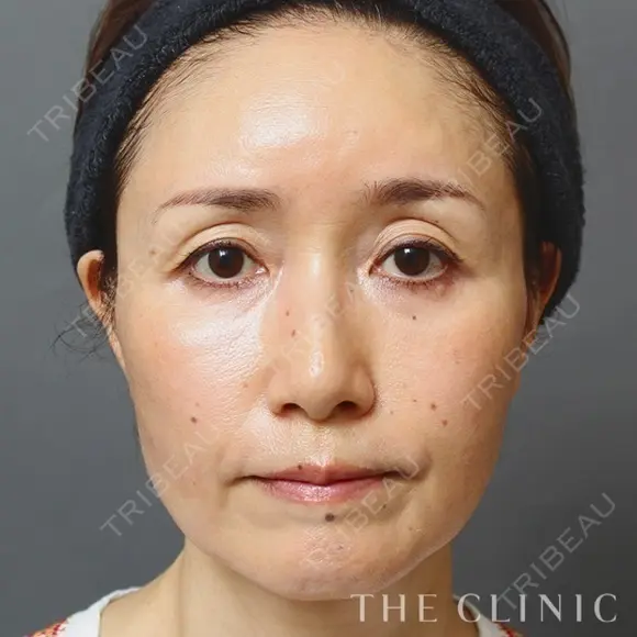 顔のSRF注入 after画像 メイン用