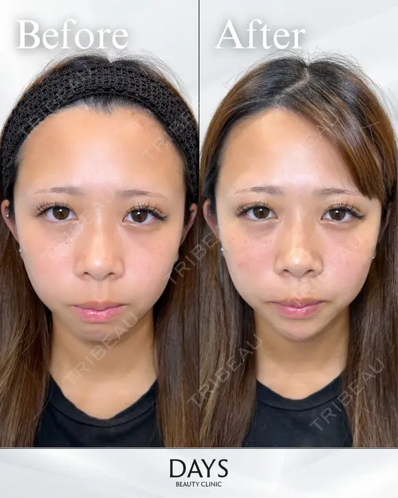 顎のヒアルロン酸注入 before画像 メイン用