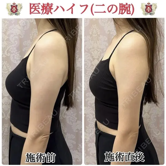 ボディハイフ after画像 メイン用