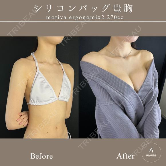 シリコンバッグ豊胸 before画像 メイン用