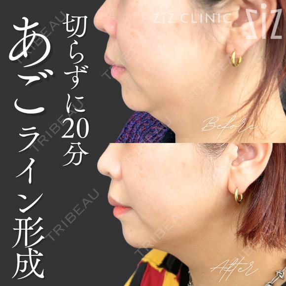 【切らずに20分】あごライン形成 after画像 メイン用