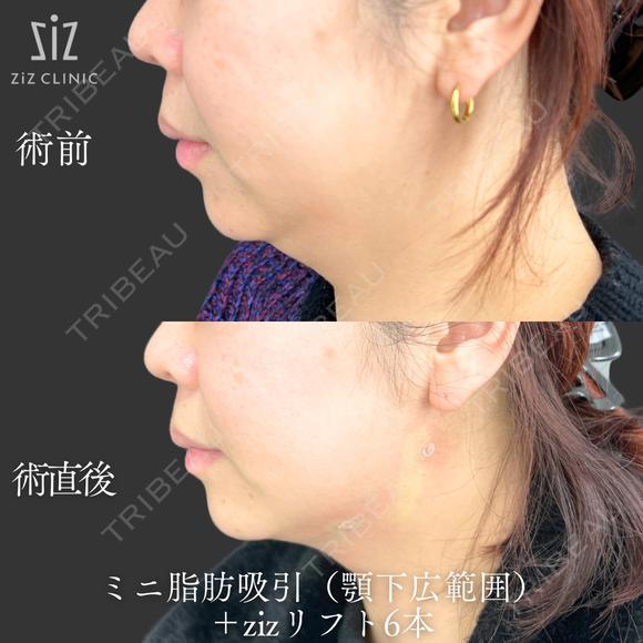 【切らずに20分】あごライン形成 before画像 メイン用
