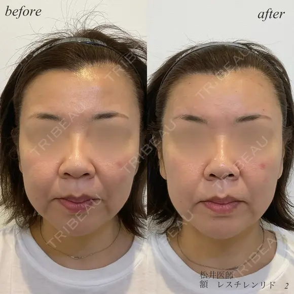 額ヒアルロン酸 before画像 メイン用