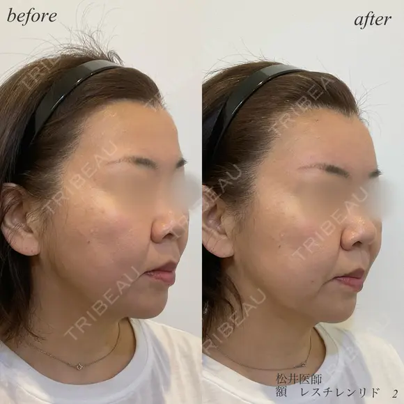 額ヒアルロン酸 after画像 メイン用