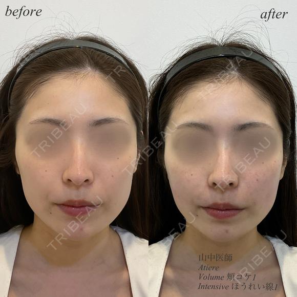 頬コケ　ほうれい線ヒアルロン酸 before画像 メイン用