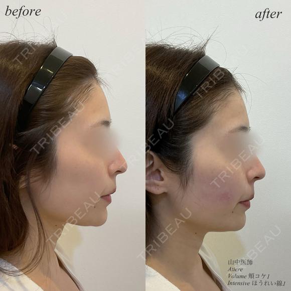 頬コケ　ほうれい線ヒアルロン酸 after画像 メイン用