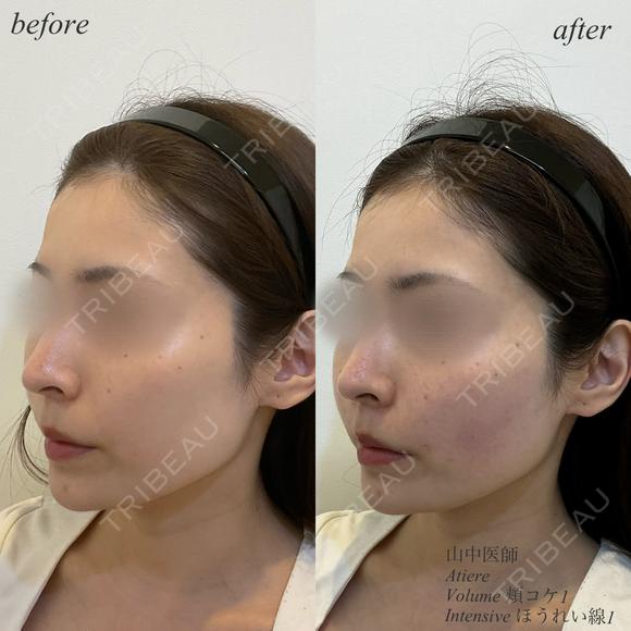 頬コケ　ほうれい線ヒアルロン酸 after画像 メイン用